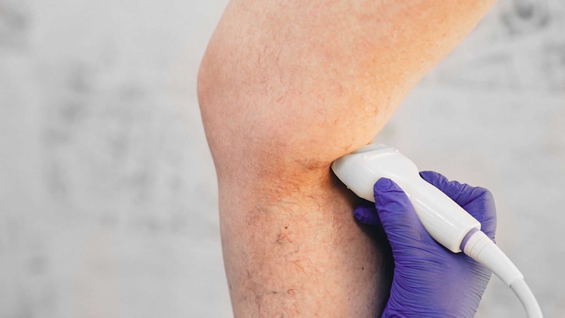 Eine Untersuchung der Beine wird durchgeführt, um die Stadien bei Gefäßerkrankungen zu erkennen. 